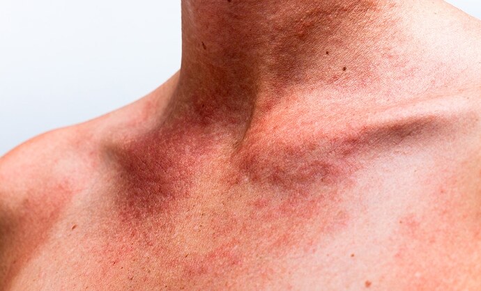 rode-vlekken-op-huid-door-stress-featured